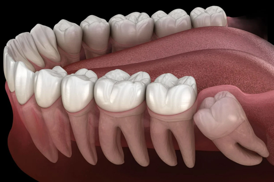 Impacted Tooth Extraction By Mr and Mrs Dentist